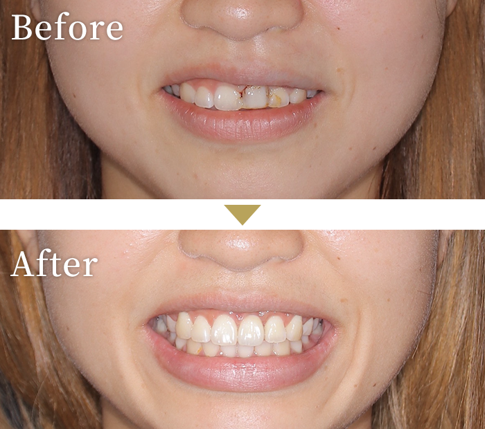 インプラント症例１