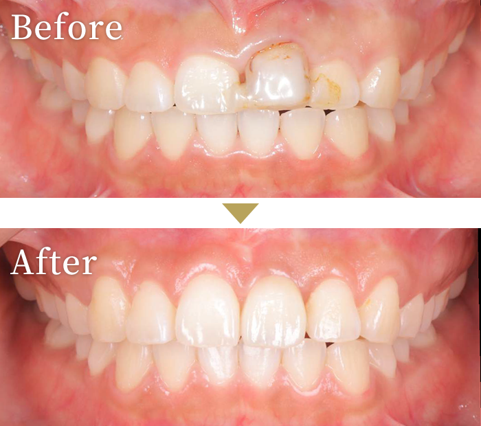 インプラント症例１