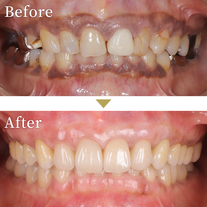 インプラント症例３