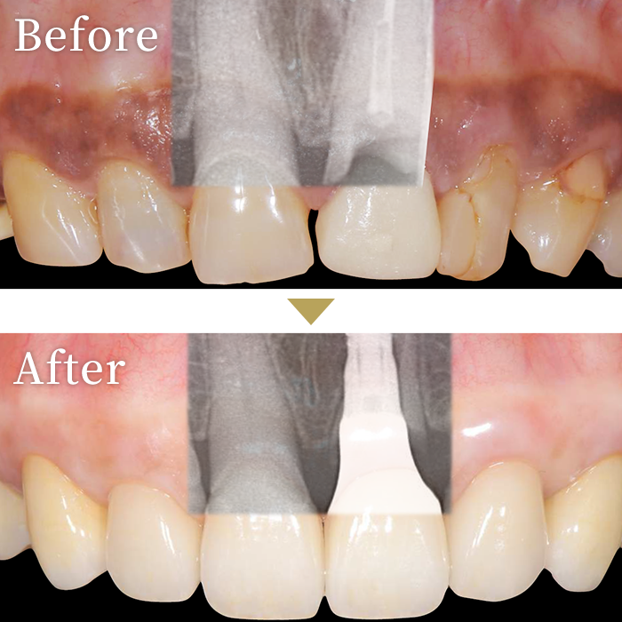 インプラント症例３
