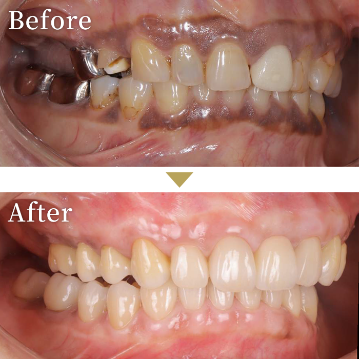インプラント症例３