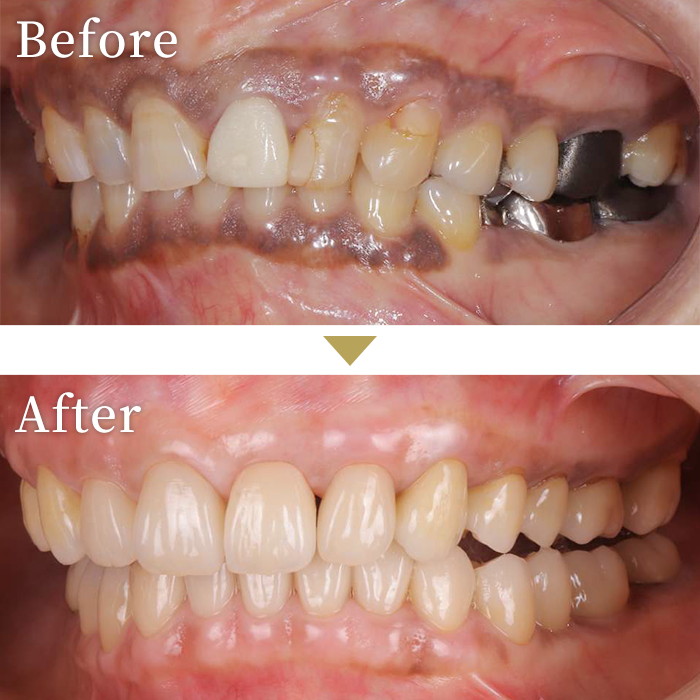 インプラント症例３