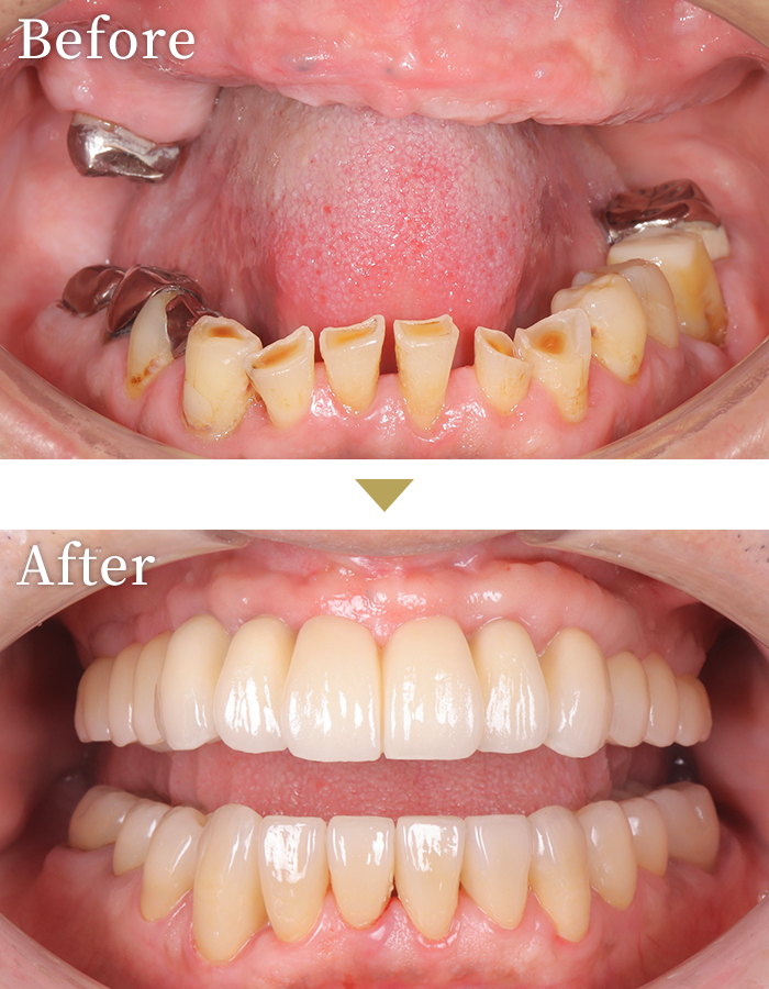 インプラント症例6