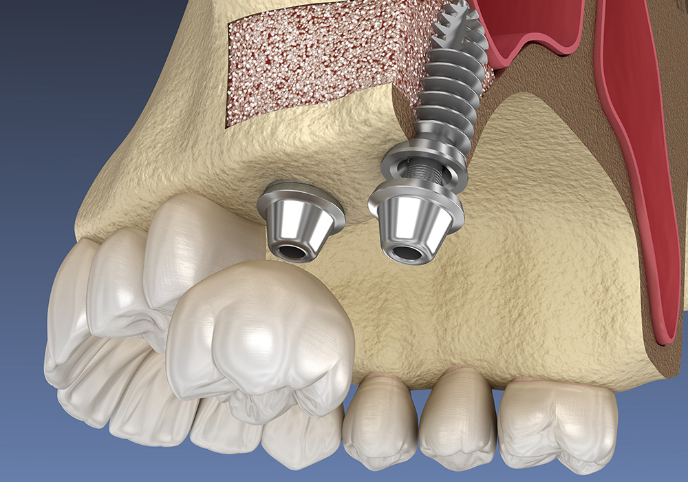 骨造成・再生療法