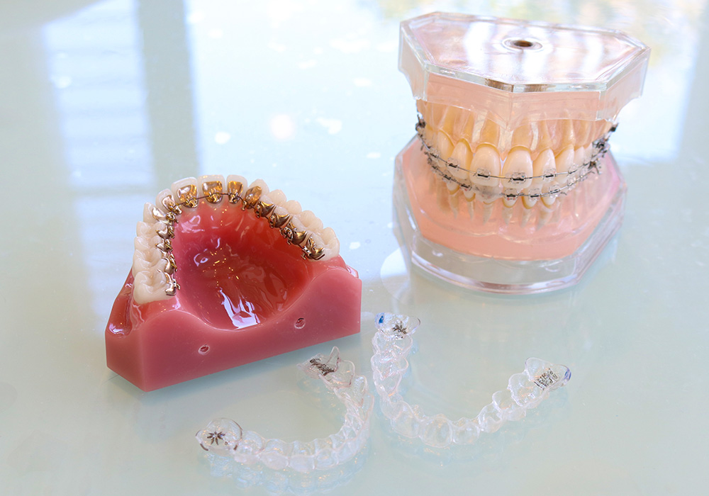 マウスピース矯正