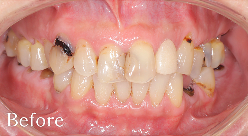 インプラント症例1 after