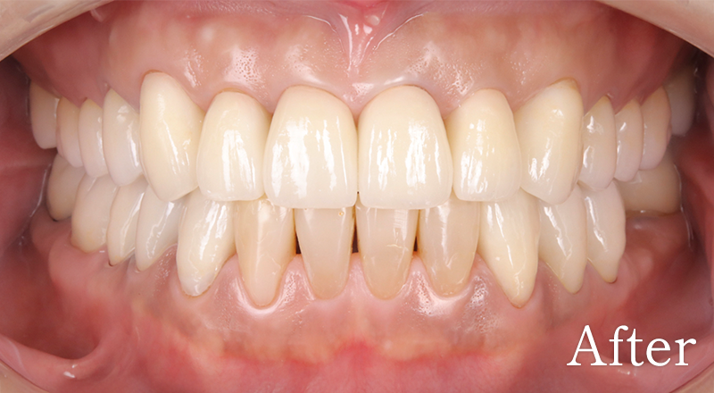 インプラント症例2 before