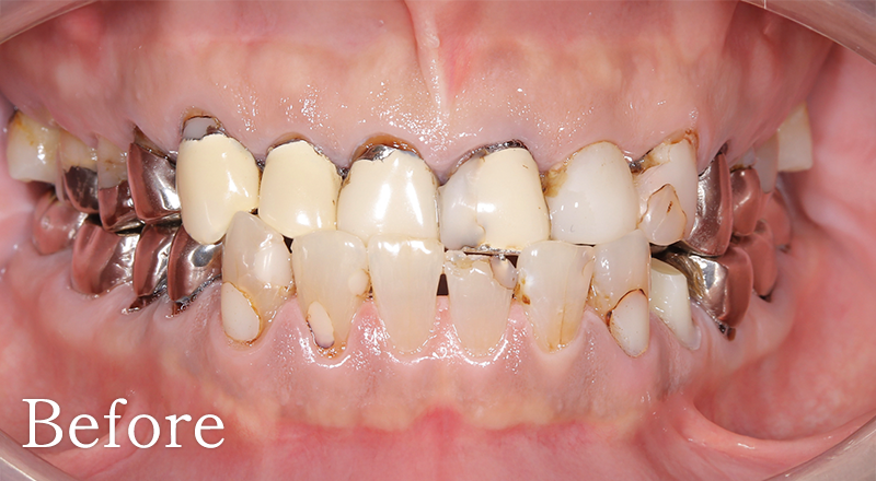 インプラント症例2 after