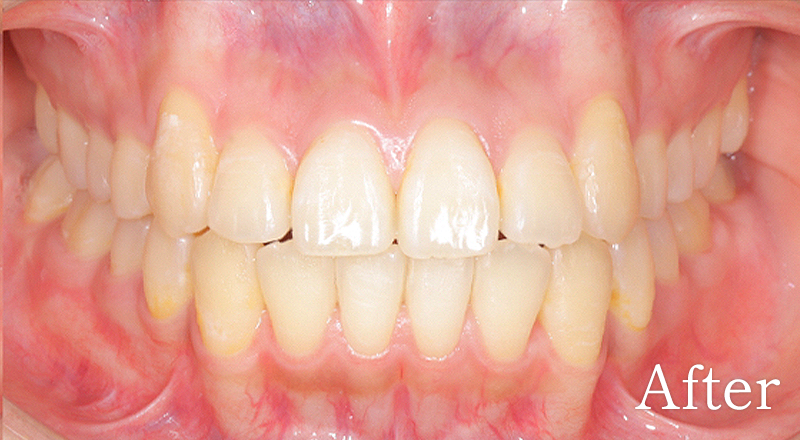 矯正歯科症例1 before