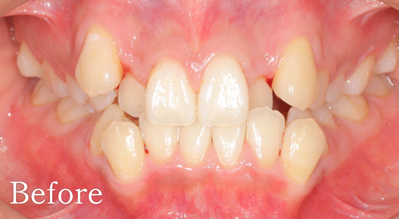 矯正歯科症例1 after